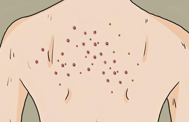 背上长痘痘dm02.jpg 背上长痘痘dm02.jpg