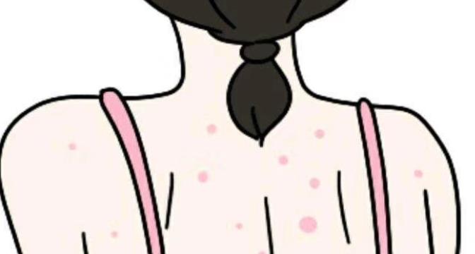 背上长痘痘dm01.jpg 背上长痘痘dm01.jpg