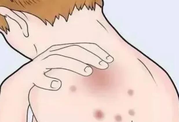 背上长痘痘dm03.jpg 背上长痘痘dm03.jpg