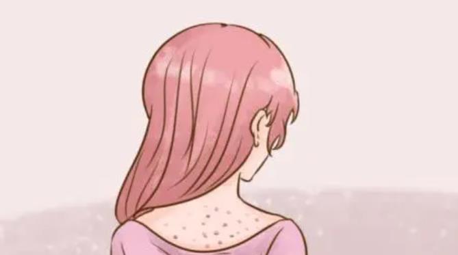 背上长痘痘dm04.jpg 背上长痘痘dm04.jpg