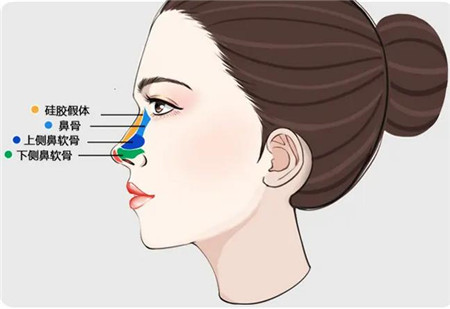 使用膨体隆鼻手术的优点是什么?