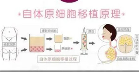 用自体脂肪填充额头有什么优势