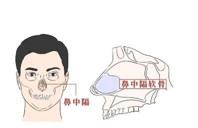 哪些因素会影响矫正鼻中隔偏曲的价格