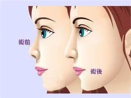 武汉大学人民医院李爱林做鼻子怎么样？隆鼻案例过程奉上~含整形价格表2023全新一览