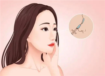成都华西医院隆鼻经历分享！三个月我也拥有小翘鼻啦~