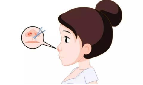 温州附一整形隆鼻修复怎么样？分享真人整形恢复过程日记+价格表收费