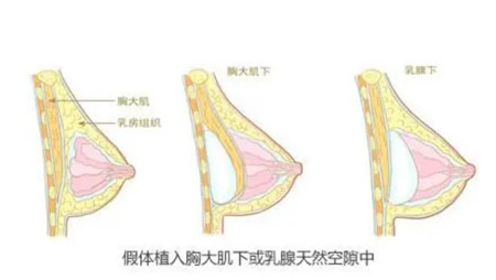 广州武警医院自体脂肪隆胸怎么样?