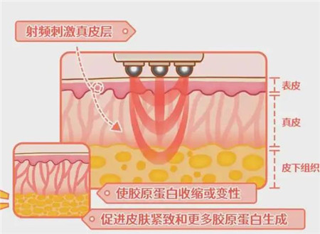 北京301医院热玛吉是真的吗?个人热玛吉经历过程分享，附2023年价格表