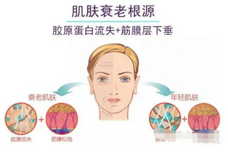 成都二医院热玛吉怎么样?做完热玛吉三个月皮肤被提拉了