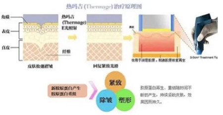 广州曙光医院热玛吉是真的吗?分享热玛吉过程评价及价格表清单了解!