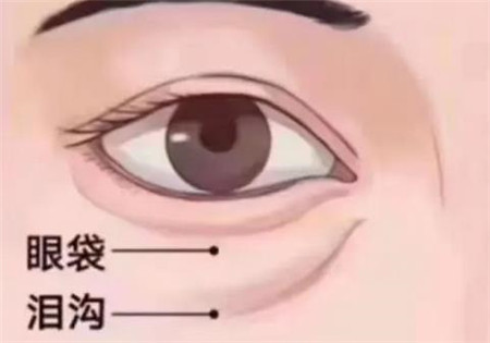 玻尿酸填充泪沟有什么好处,要多少钱