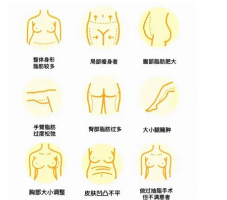吸脂术有哪些风险,吸脂会反弹吗