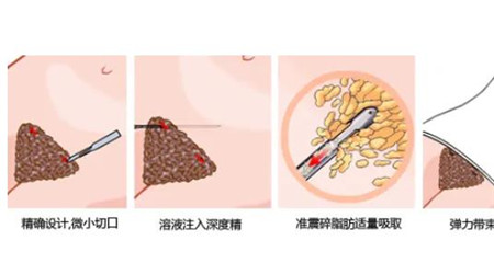 吸脂越多越好吗?可以帮助减肥吗