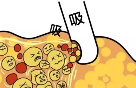 手臂吸脂的好处是什么,有什么副作用
