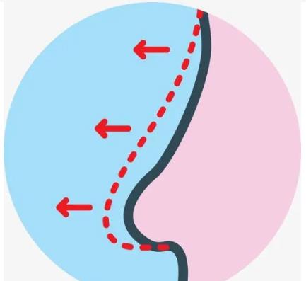 需要取出膨体隆鼻材料吗