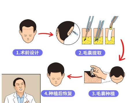 南京韩辰做植发怎么样?分享我的植发经历以及价格表