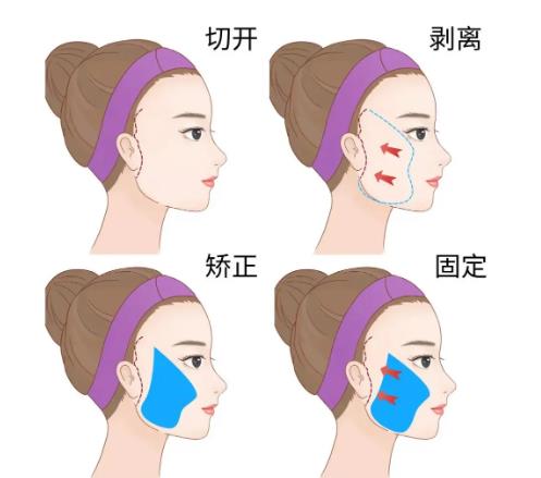 北京301医院拉皮手术好吗？拉皮手术案例:皮肤紧致有弹性！内含价格表