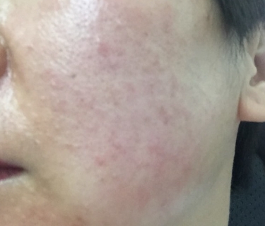 一热就脸红是角质层薄吗?