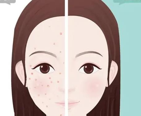 果酸嫩肤8.jpg