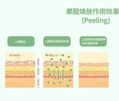 果酸换肤去除痘印的效果怎么样