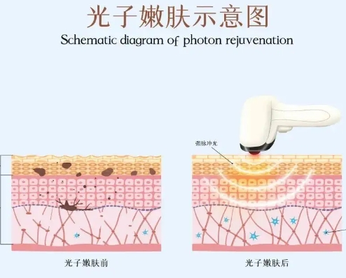 光子嫩肤1.jpg
