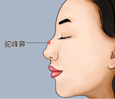 驼峰鼻矫正恢复时间受哪些因素影响