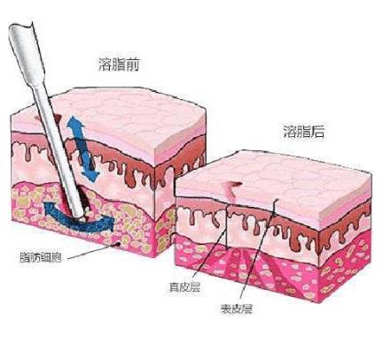 注射溶脂可以去眼袋吗,好处是什么