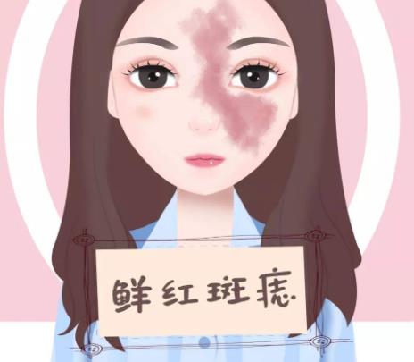 哪些人适合激光调节鲜红斑痣