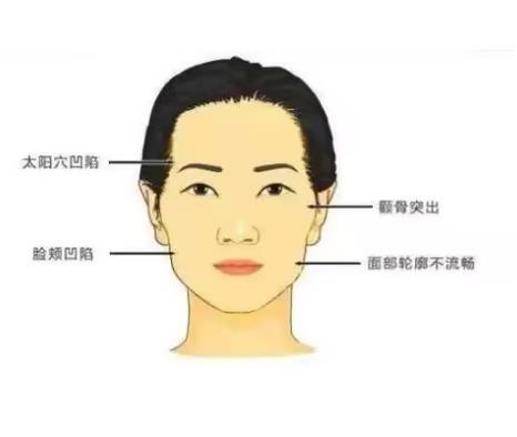颧骨内推要多少钱,颧骨内推有什么副作用