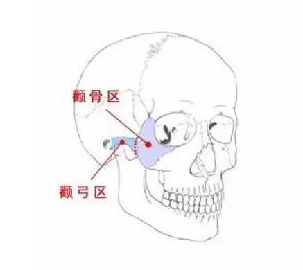 颧骨提升术有风险吗，后遗症有哪些