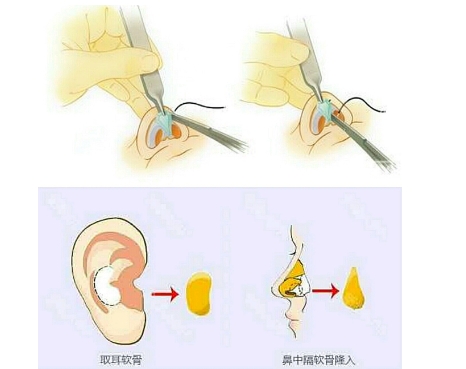 耳软骨垫鼻尖有什么好处?