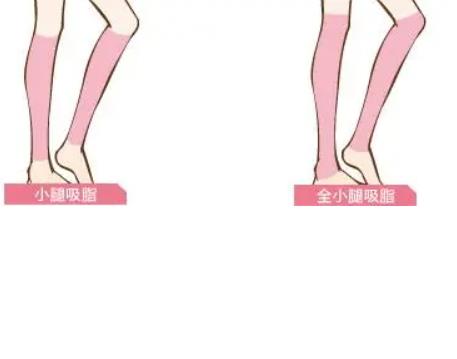 小腿吸脂.jpg