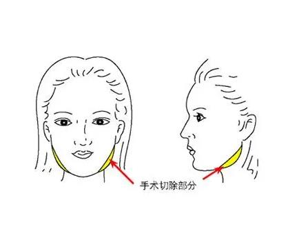 颧骨提升的效果能维持多久