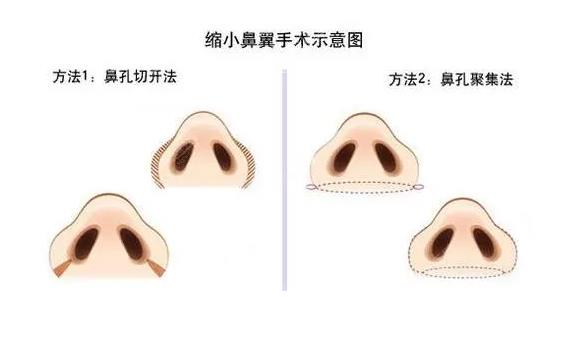 有多少种缩小鼻尖的方法?