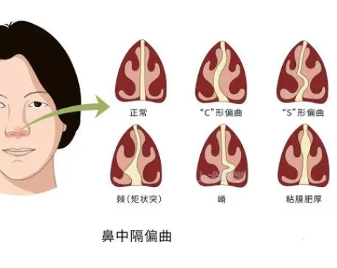 鼻中隔偏曲有哪些症状,是否需要手术?