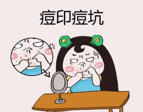 皮秒可以去除痘印吗