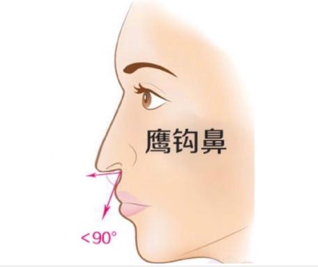 鹰钩鼻矫正有效果吗,多长时间才能恢复