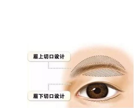 提眉手术有哪些效果和注意事项?
