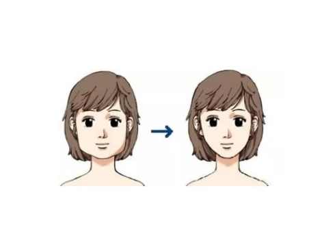 面部吸脂3.jpg