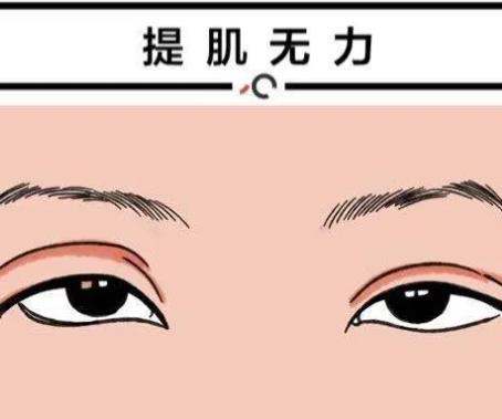 上睑下垂矫正手术的优点及方法