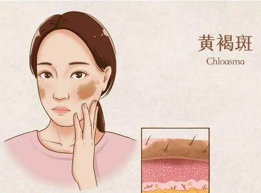黄褐斑4.jpg