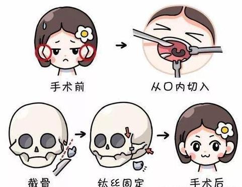 颧骨垫高.jpg