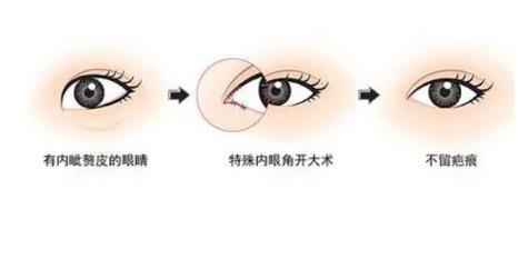 眼皮吸脂术有哪些优点，效果如何