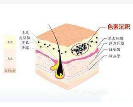 彩光嫩肤效果如何,会反弹吗?