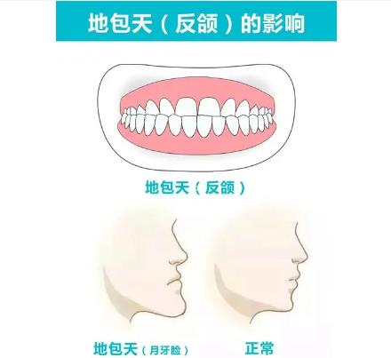 矫正地包天.jpg