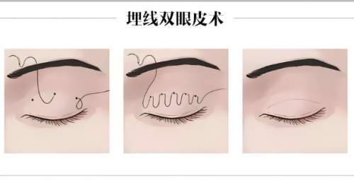 山东双眼皮医生推荐一览，5 位 “眼技派” 医生 pk，小白速来抄作业！