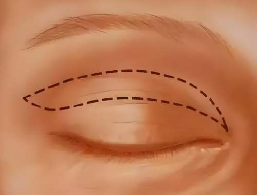 双眼皮一个月和三个月的变化的描述怎么样？赶紧来看看案例详情