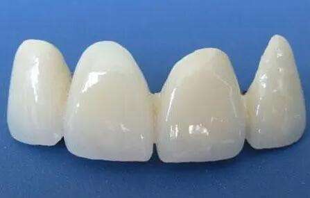 烤瓷牙的种类及价钱是多少？盘点种类、价格、注意事项来了