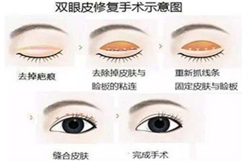 陈贵宗割双眼皮好吗？医生详情介绍