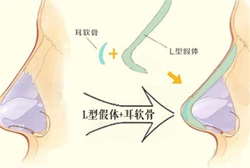 男生隆鼻很明显吗？男生隆鼻术后多久恢复？
